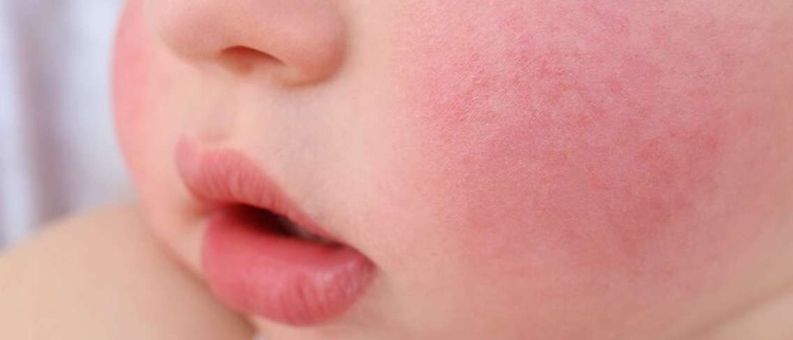 5 Causes Of Red Cheeks In Babies Is It Dangerous World Today News