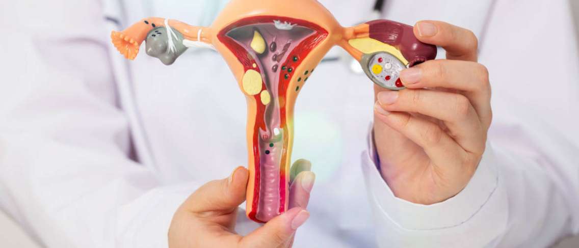 Upaya Memperpanjang Peluang Hidup Penderita Kanker Ovarium