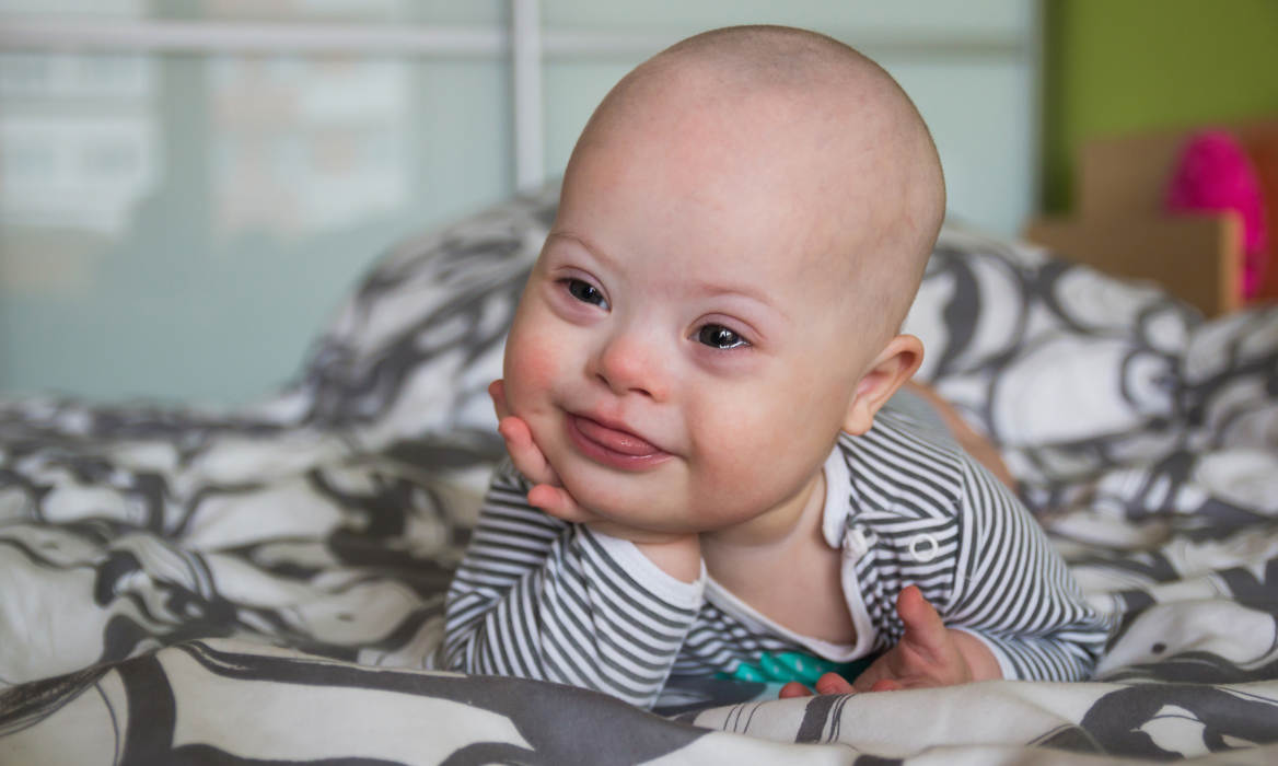 Ketahui Penyebab Down Syndrome pada Bayi