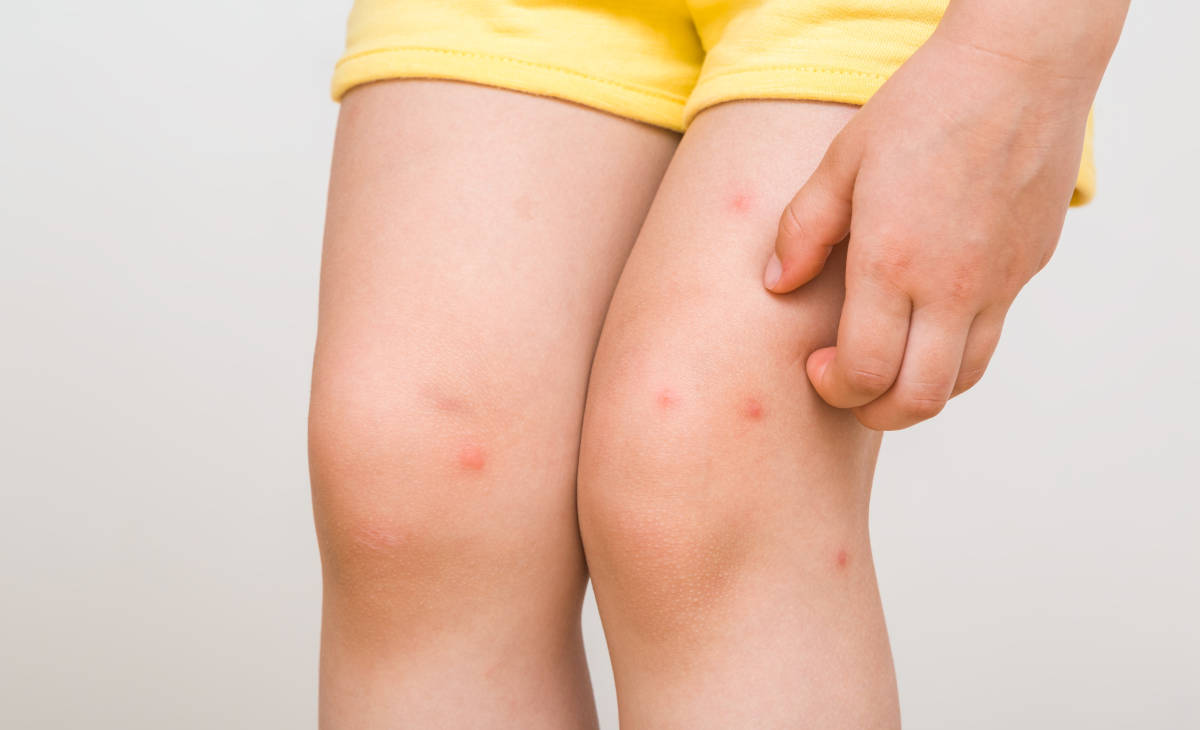 Anak Sering Bisulan Benarkah Karena Terlalu Banyak Makan Telur?