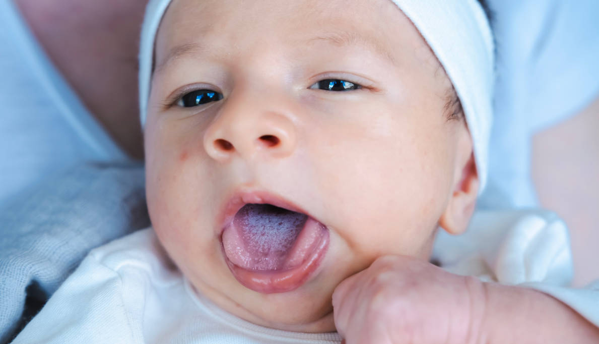 Bayi dengan infeksi jamur di mulut