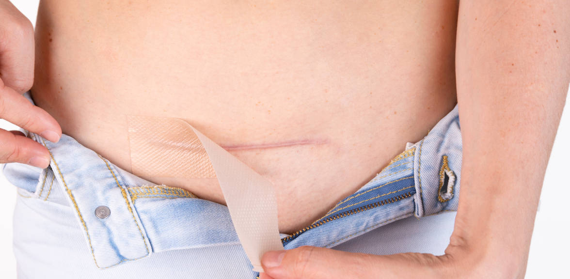 7 Cara Agar Jahitan Caesar Cepat Kering