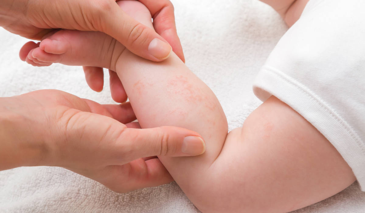 Bayi mengalami gejala alergi berupa ruam di kulit