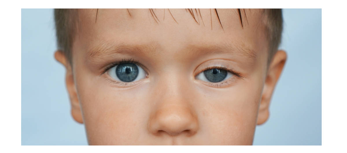 Ptosis atau kelopak mata turun 