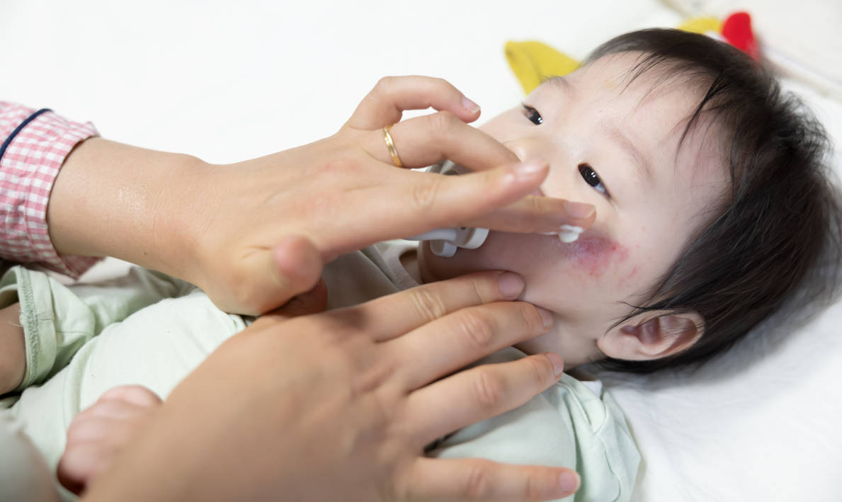 Kenali Ciri-ciri Alergi Susu Sapi pada Anak