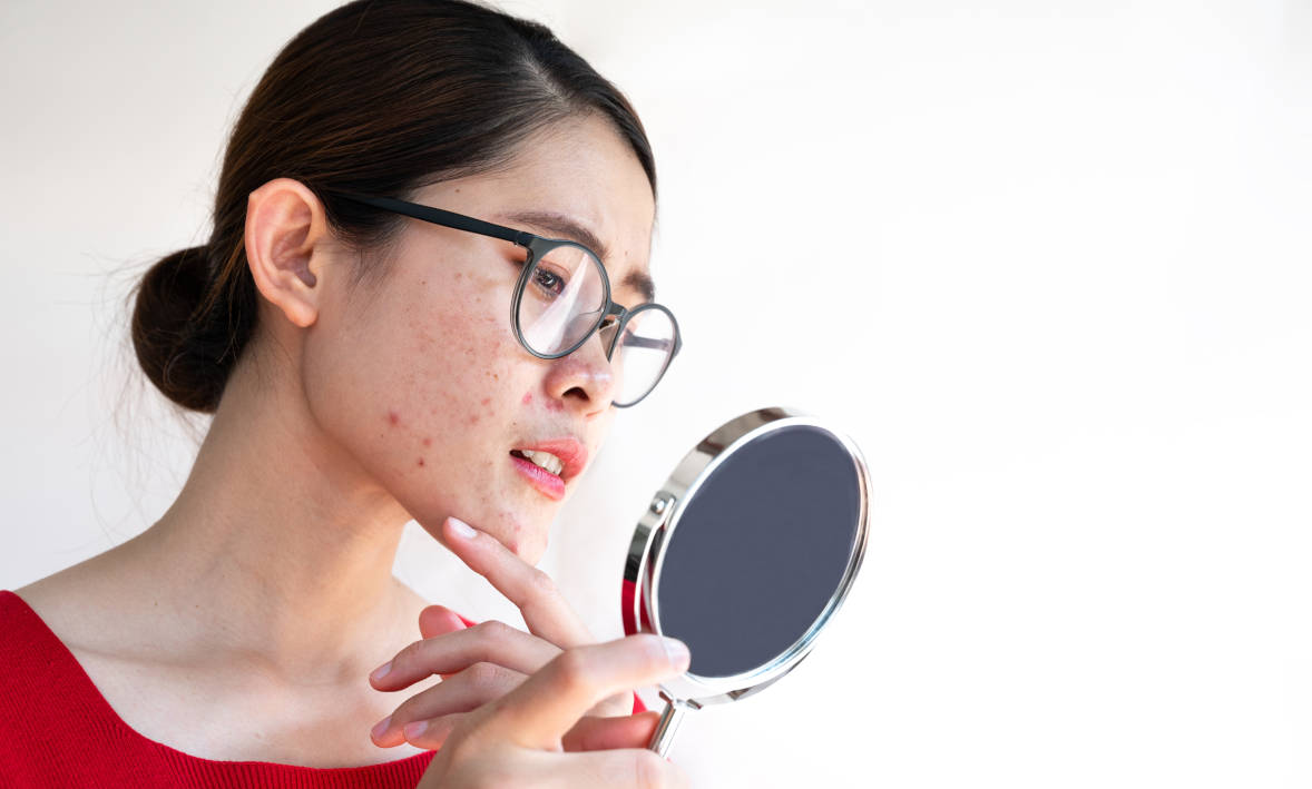 Menyamarkan Luka Bekas Jerawat dengan Kombinasi Terapi Laser dan Skinbooster
