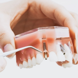 3 Cara Mudah Merawat Gigi Palsu