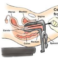 5 Alasan Melakukan Pap Smear, Nomor 2 Kamu Harus Tahu!