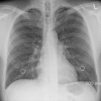 5 Fakta tentang Pengobatan Pneumonia