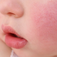 5 Penyebab Pipi Merah pada Bayi, Apakah Berbahaya?