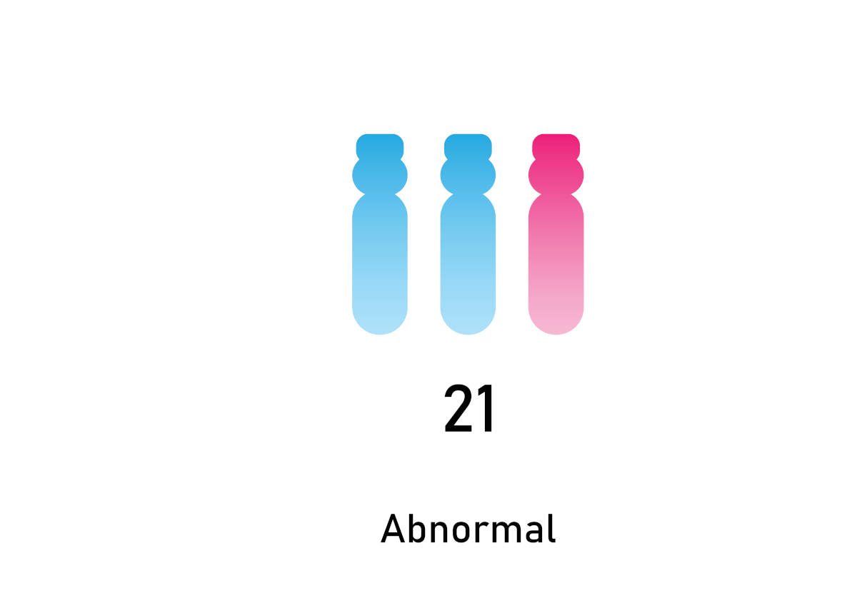 Kelainan Trisomi: Penyebab, Jenis, Gejala, dan Penanganannya
