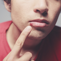 6 Penyebab Luka pada Bibir, Salah Satunya Gejala Herpes!