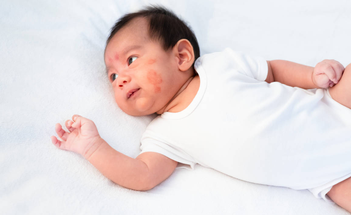 6 Penyebab Ruam di Pipi Bayi 