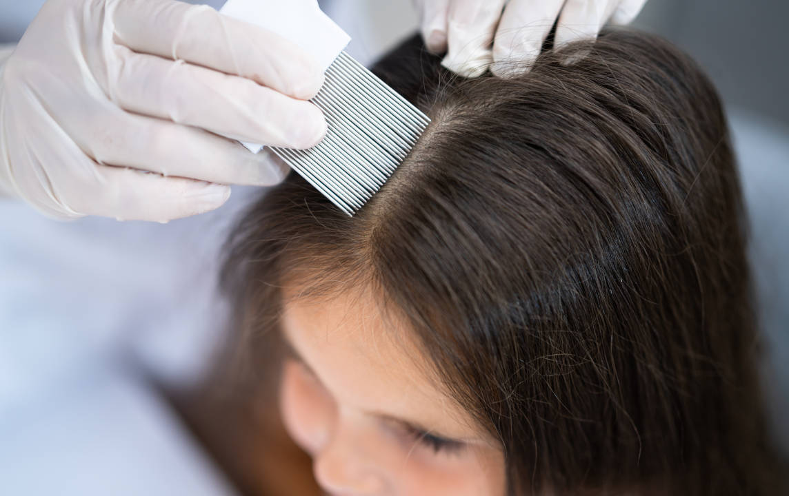 Hiii..Rambut Anak Tiba-tiba Berkutu? Ini Cara Tepat Mengatasinya