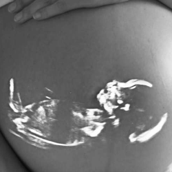 3 Kelainan Trisomi yang Harus Diketahui Ibu Hamil!