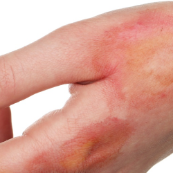 Jenis-Jenis Luka Bakar dan Perawatannya