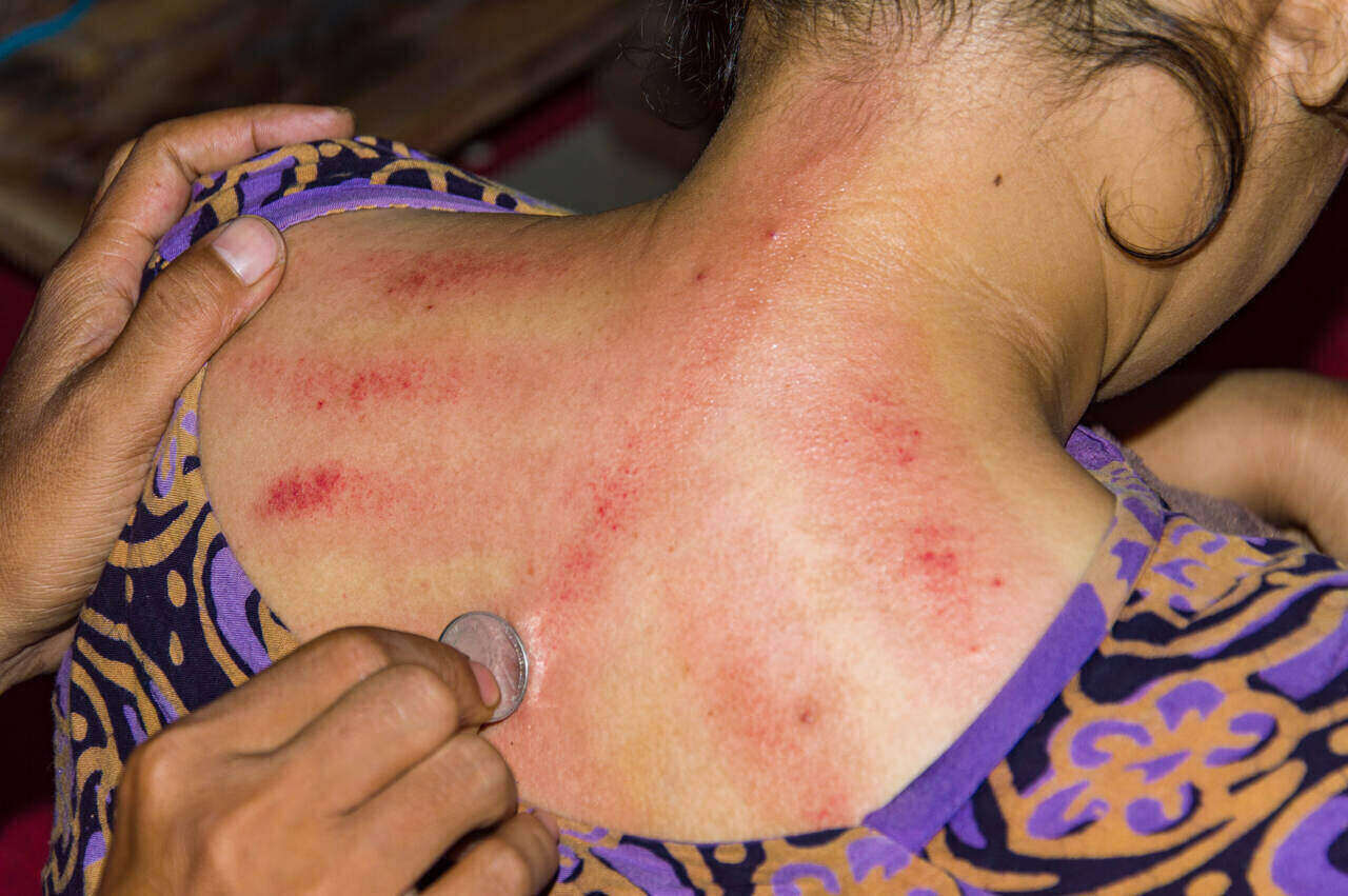 Apakah Ibu Hamil Boleh Kerokan? Intip Syaratnya, Mums!