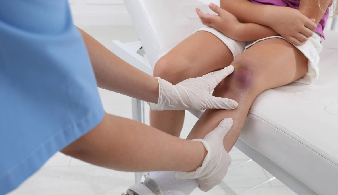 Penyebab dan Cara Mengatasi Memar pada Anak