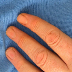 Ini Penyebab Serangan Jantung dan Perbedaannya dengan Gagal Jantung