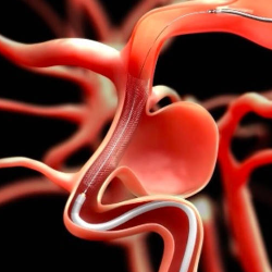 Stroke di Usia Muda Tanpa Riwayat Hipertensi, Hati-Hati Aneurisma!