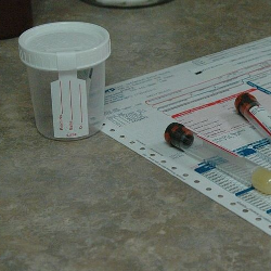 Ada Protein dalam Urine, Menandakan Gangguan Ginjal