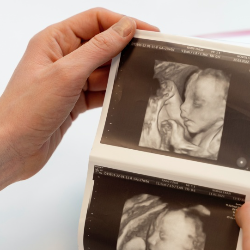 Kehamilan Mums Berisiko? Lakukan USG Fetomaternal