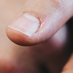 Bukan Hanya Jamur Penyebab Kuku Kuning di Jari Kaki