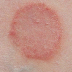 Duuh, Kena Kurap? Coba Bahan Alami Ini untuk Menghilangkannya!