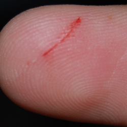 Ayo Kenali 3 Jenis Hemofilia