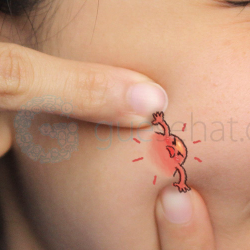 Jerawat Akibat Purging Berbeda dengan Jerawat Breakout, Lho!