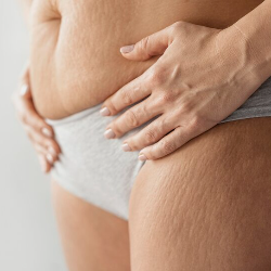 Bagaimana ya, Cara Menghilangkan Stretch Marks Membandel yang Telanjur Putih?