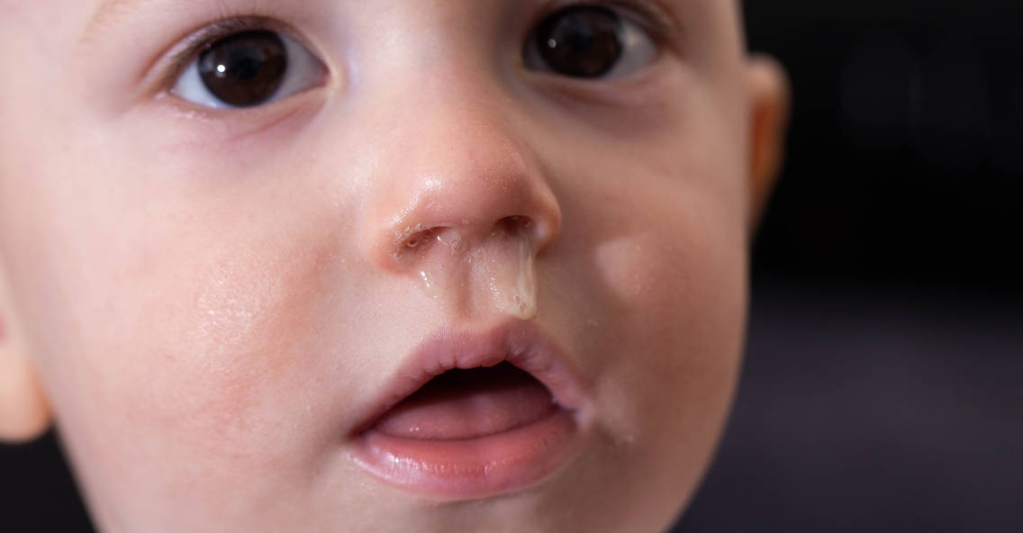 Jenis-jenis Pilek pada Bayi dan Anak Dilihat dari Warna Ingusnya