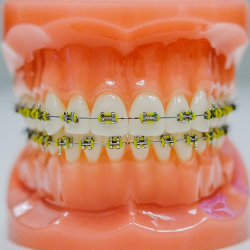 Bolehkah Ibu Hamil Pakai Behel?