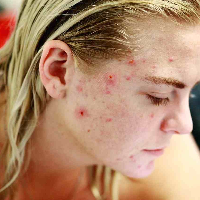 Butuh Perawatan Khusus, Ini Tanda-tanda Kamu Mengalami Jerawat Hormonal