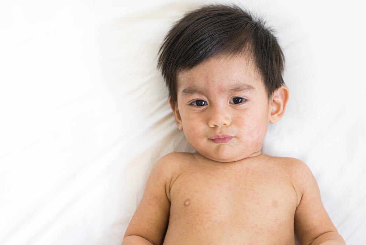 Campak pada Anak Meningkat! Kenali Gejala dan Mencegah Penularannya!
