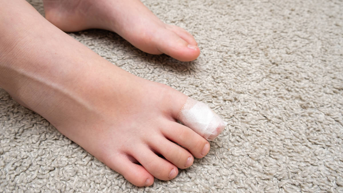 Kuku Anak Cantengan, Bagaimana Mengobatinya?