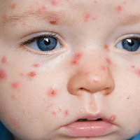 Penyakit Varisela pada Anak dan Pencegahannya