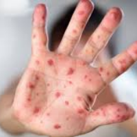 Ditemukan Satu Kasus di Indonesia, Inilah Fakta Penting Cacar Monyet yang Perlu Diingat!