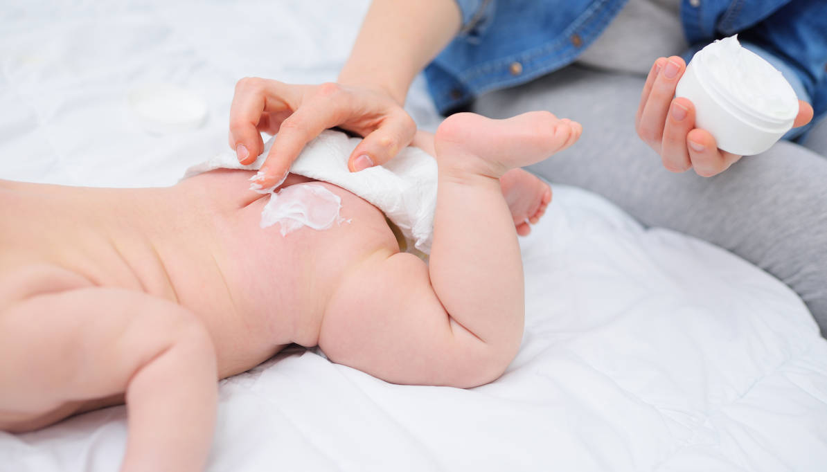 Jangan Panik, Ini 8 Cara Mengatasi Ruam Popok pada Bayi