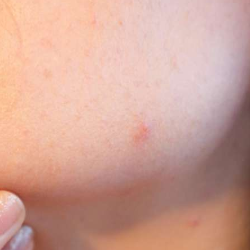 Cegah Jerawat Muncul dengan Cara Ini, Yuk!