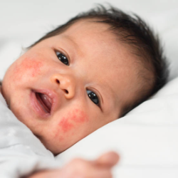 Dermatitis Atopik Kambuh Berulang? Ini Dia Cara Aman Mengatasi Dermatitis Atopik pada Bayi