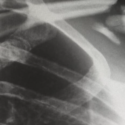 Hati-hati, Diabetes Meningkatkan Risiko Osteoporosis!