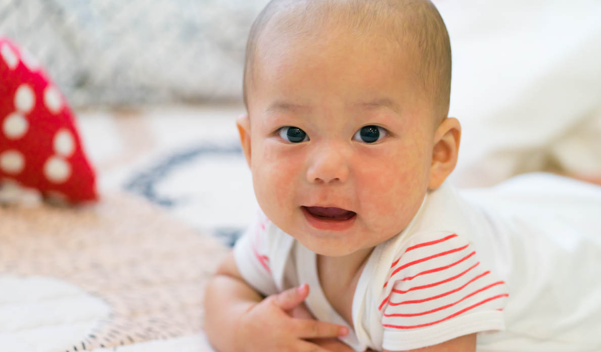 Bayi mengalami demam disertai ruam kemerahan di kulit