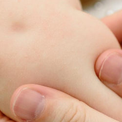 Mums, Ini Gejala Cacar Monyet pada Anak!