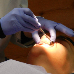 Gigi Berlubang Bisa Menyebabkan Sinusitis