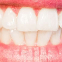 Kebiasaan Ini Bikin Gigi Sensitif Semakin Parah!