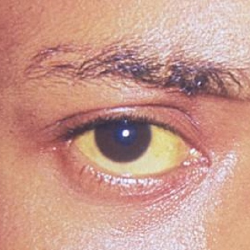 Wabah Hepatitis A di Pacitan, Pentingnya Perilaku Hidup Bersih!