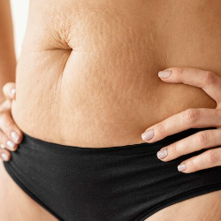 Mums, Ini Dia Langkahnya agar Bebas Stretch Marks saat Hamil