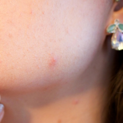 Jerawatan Selama di Rumah Aja? Ini Penyebabnya!