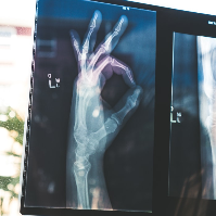 Jika Anak Kekurangan Kalsium, Inilah yang Harus Dilakukan, Mums